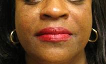 Hyaluronic Acid After